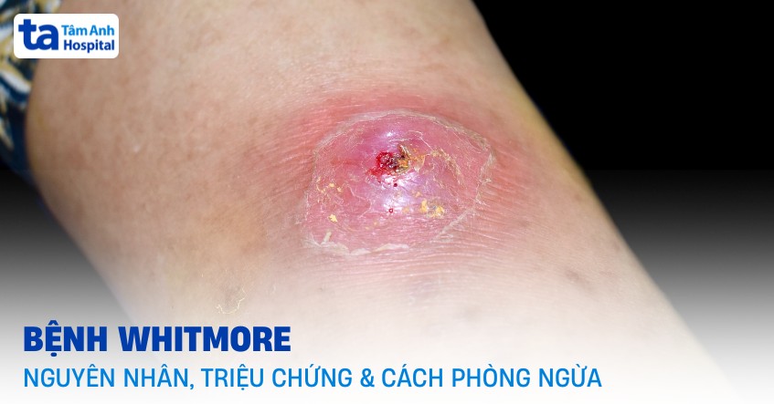 Hình ảnh bệnh Whitmore