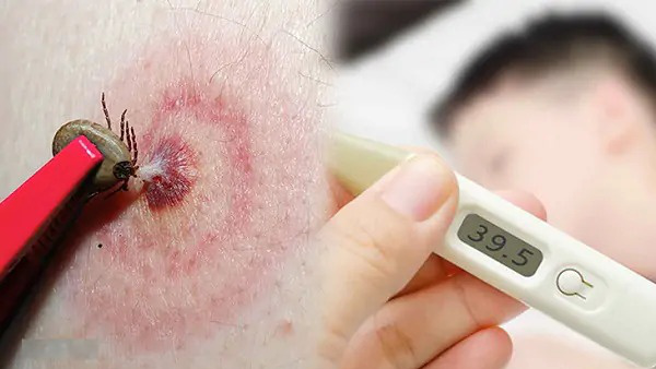 Bệnh Babesiosis ở người qua vết cắn ve
