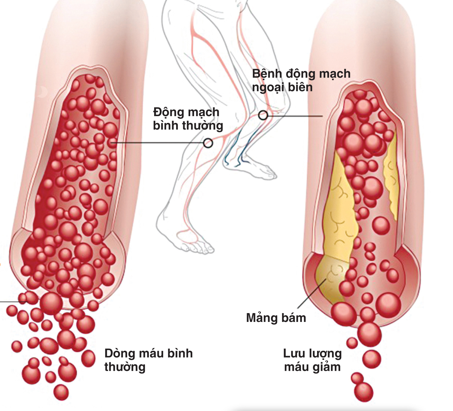 Triệu chứng bệnh động mạch ngoại biên