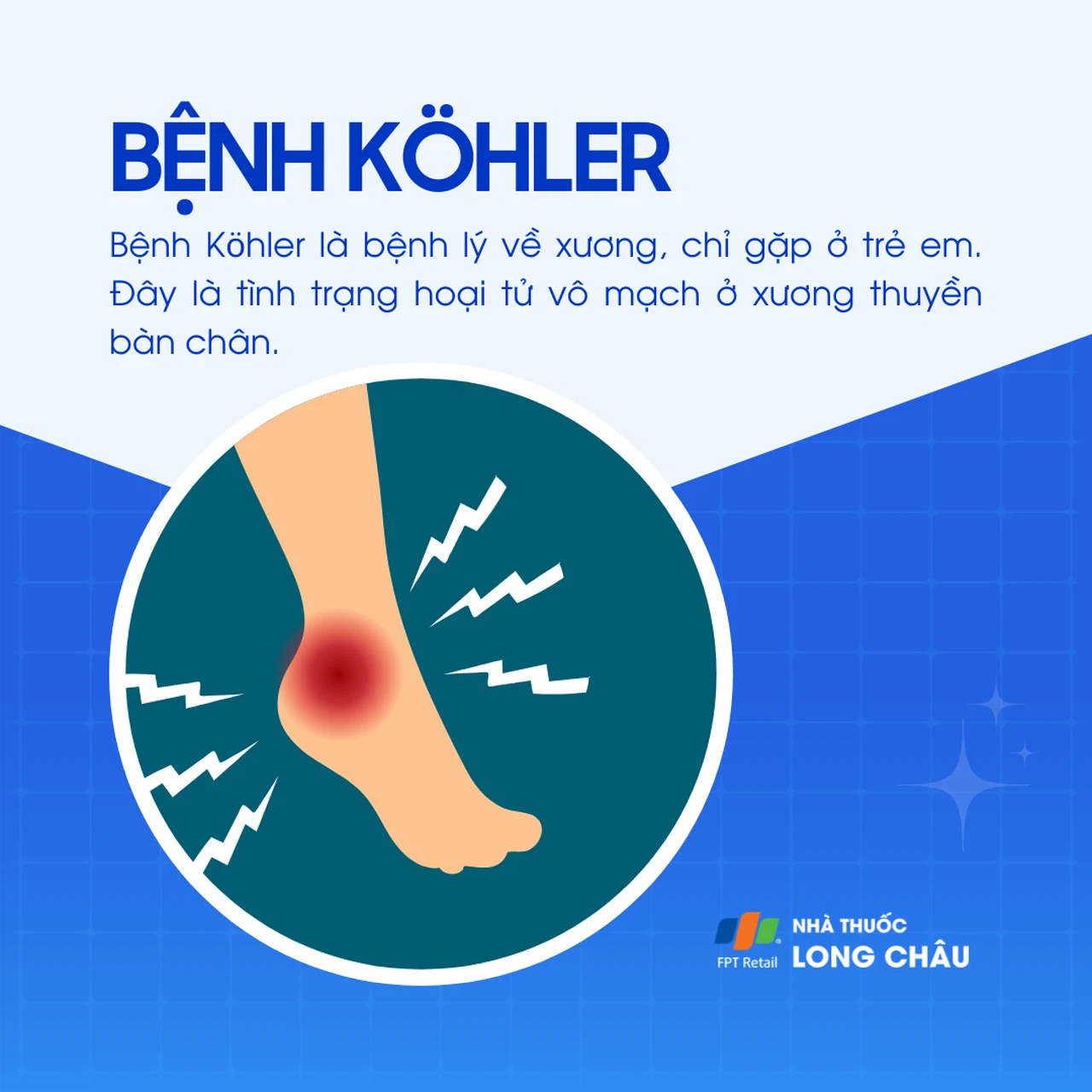 Minh họa bệnh xương Köhler ở trẻ