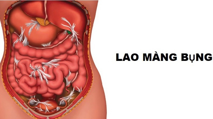Lao Màng Bụng: Triệu Chứng, Nguyên Nhân, Chẩn Đoán và Cách Điều Trị 7 Hình ảnh minh họa bệnh lao màng bụng