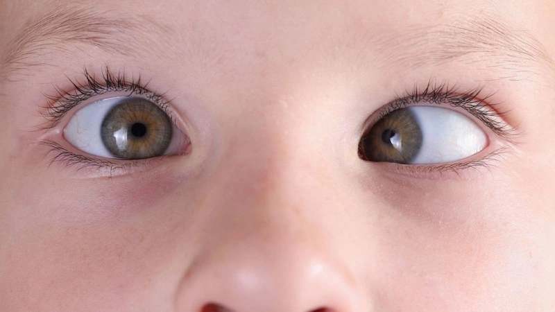 Rung Giật Nhãn Cầu (Nystagmus): Khi Đôi Mắt Chuyển Động Không Kiểm Soát 8 Rung giật nhãn cầu bẩm sinh ở trẻ