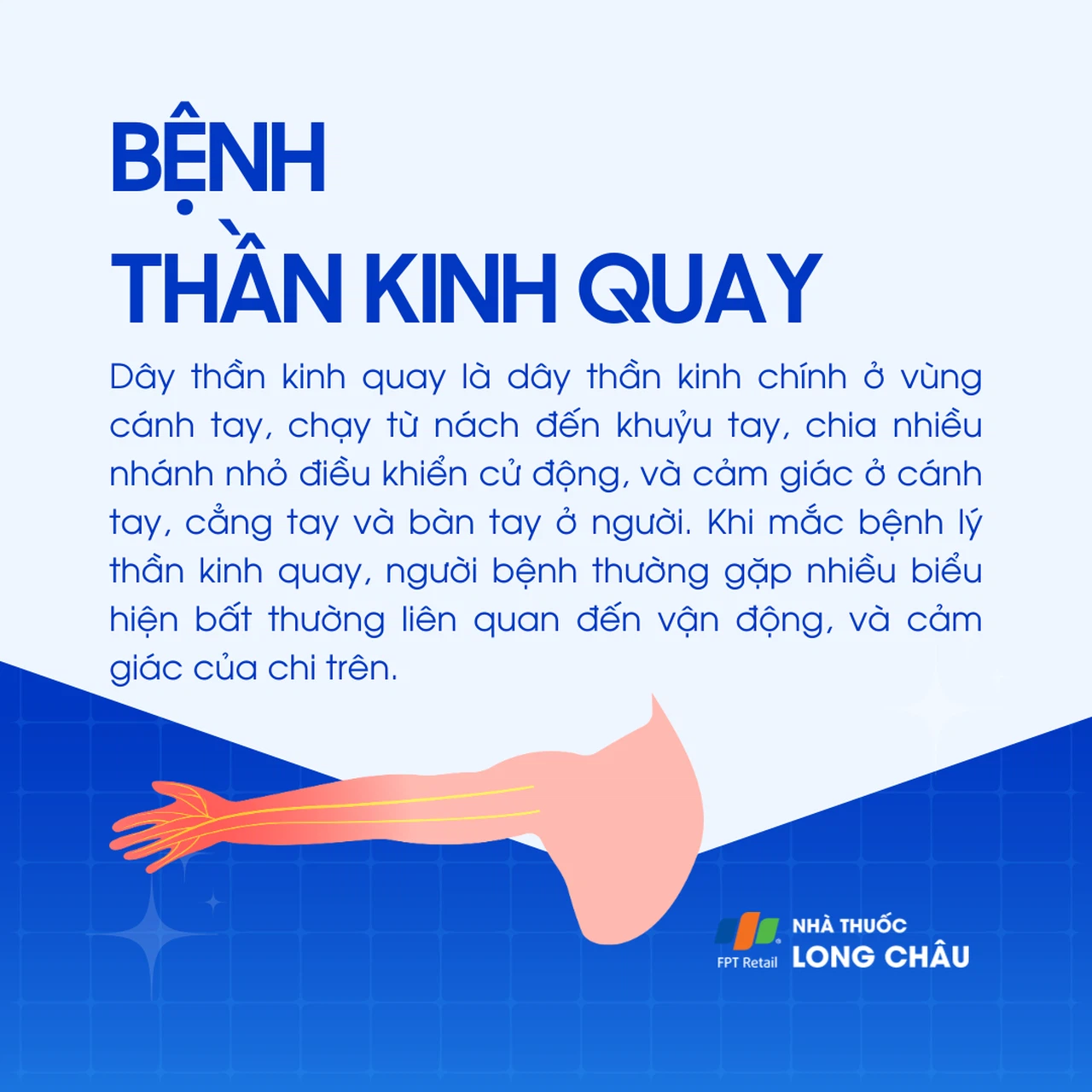 Tổn thương thần kinh quay