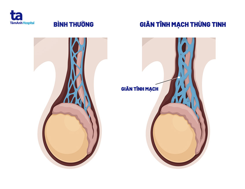 Giãn tĩnh mạch thừng tinh