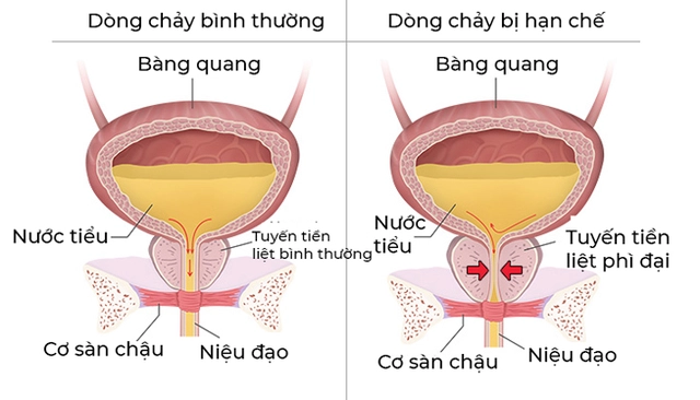 Hình ảnh biểu hiện bí tiểu ở người lớn
