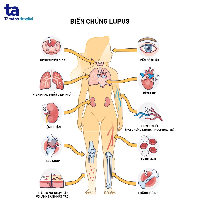 Tràn dịch màng phổi do lupus