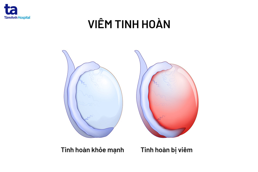 Biến chứng viêm tinh hoàn do quai bị