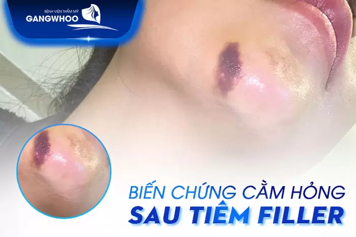 Hoại tử da sau tiêm filler