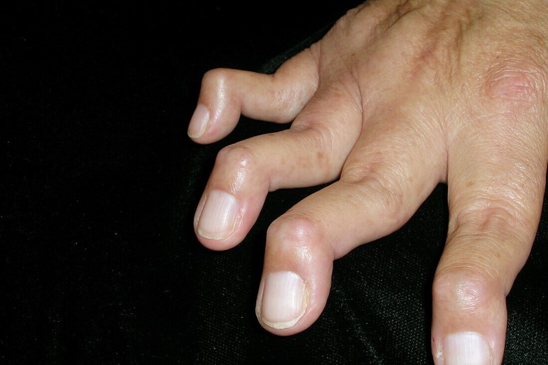 Biến dạng cổ thiên nga