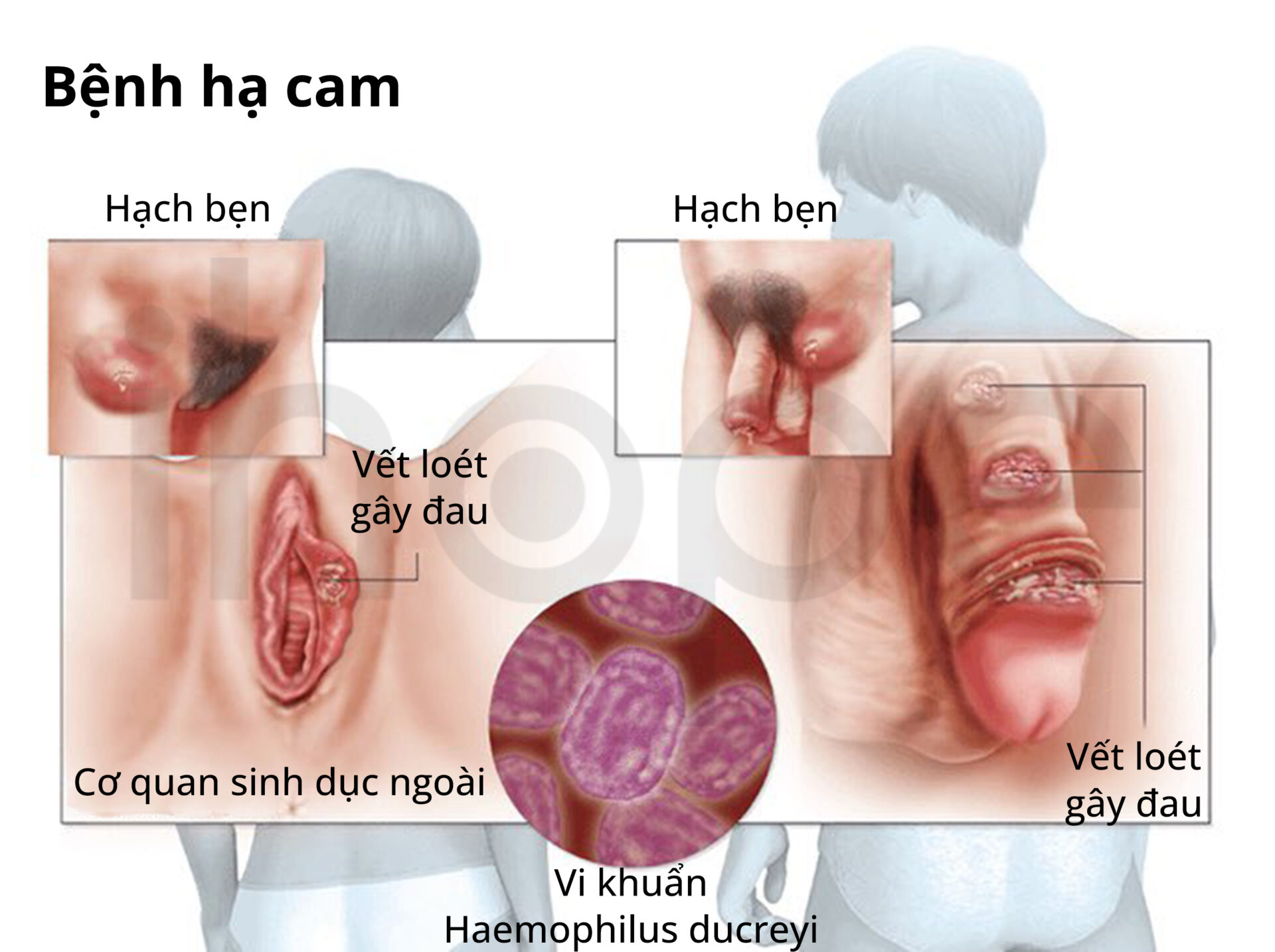 Triệu chứng hạ cam mềm