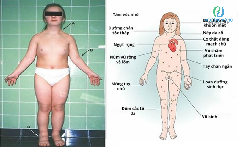 Biểu hiện lâm sàng của Turner