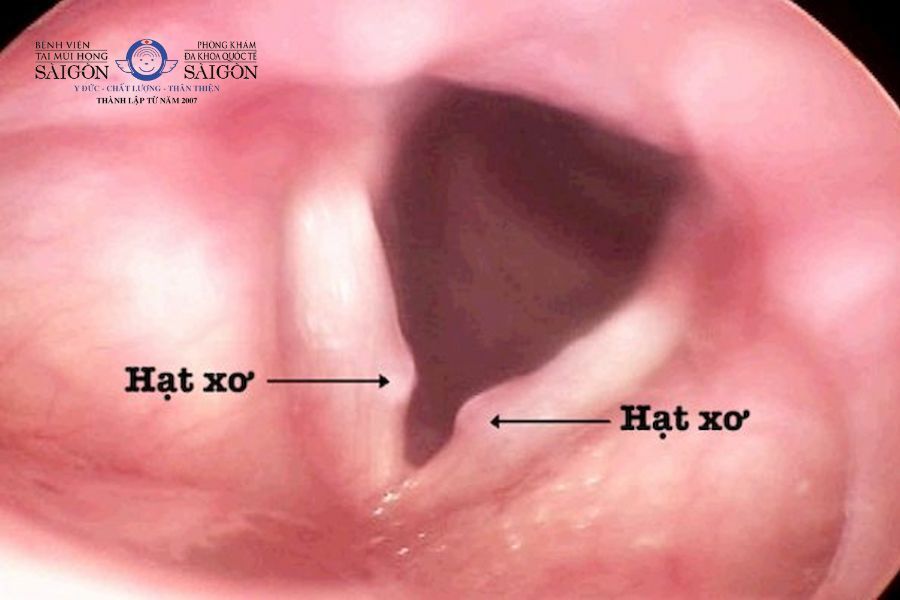 Biểu hiện hạt dây thanh quản