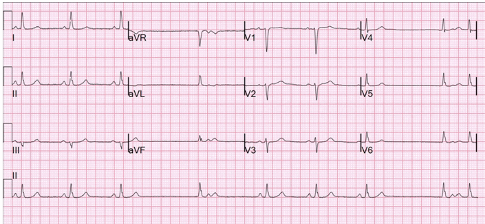 Block xoang nhĩ: Triệu chứng, nguyên nhân và phương pháp điều trị hiệu quả 7 Hình ảnh ECG block xoang nhĩ độ II