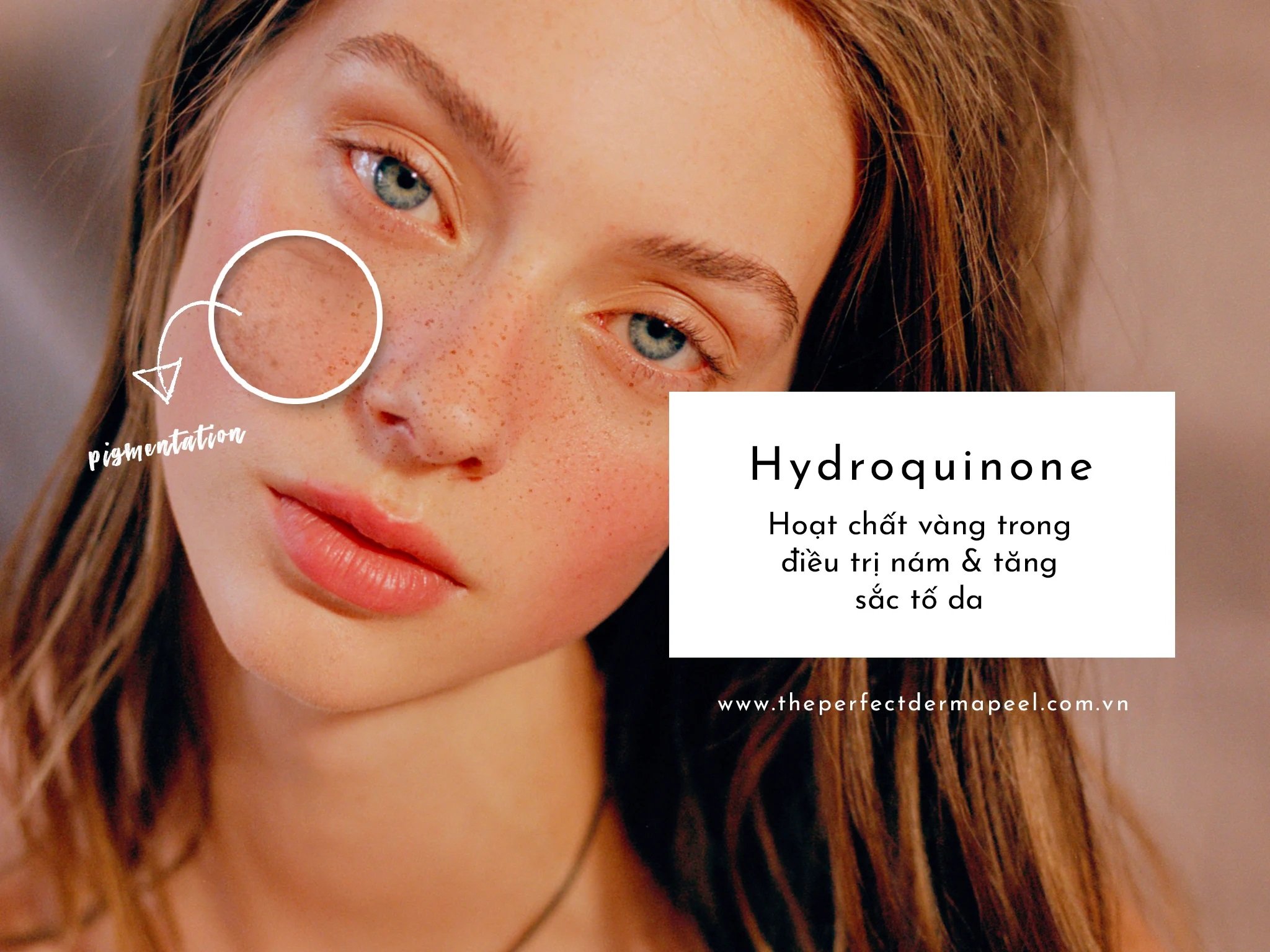 Điều trị nám với hydroquinone