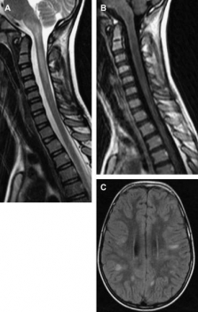 MRI não viêm tủy lan tỏa