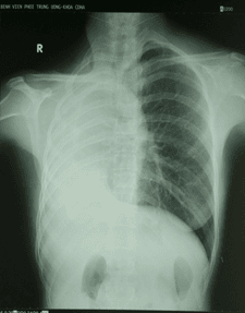 CT phổi trẻ sơ sinh