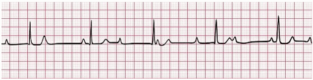 ECG block nhĩ thất cấp 3