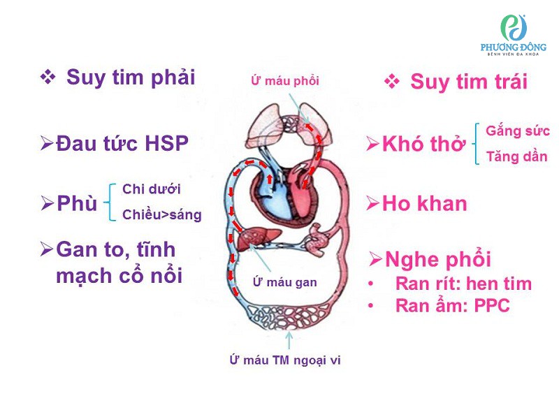 phân độ suy tim trái theo NYHA