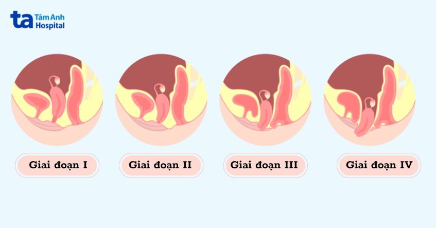 các mức độ sa sinh dục