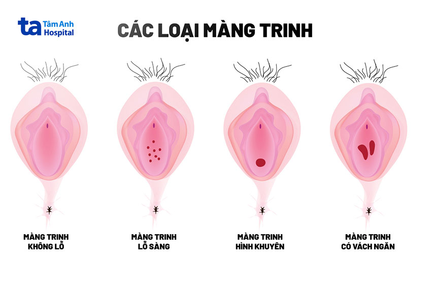 Các hình dạng màng trinh