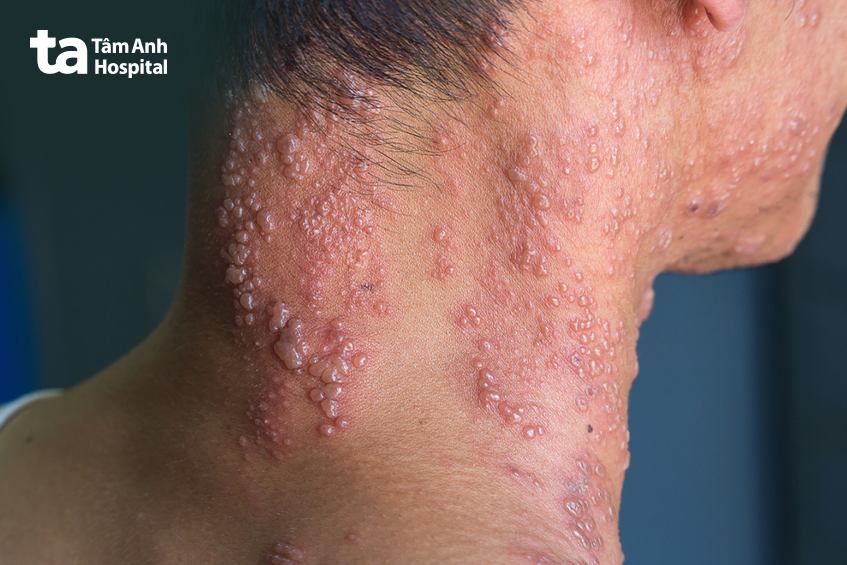 Các dạng tổn thương Zona trên da