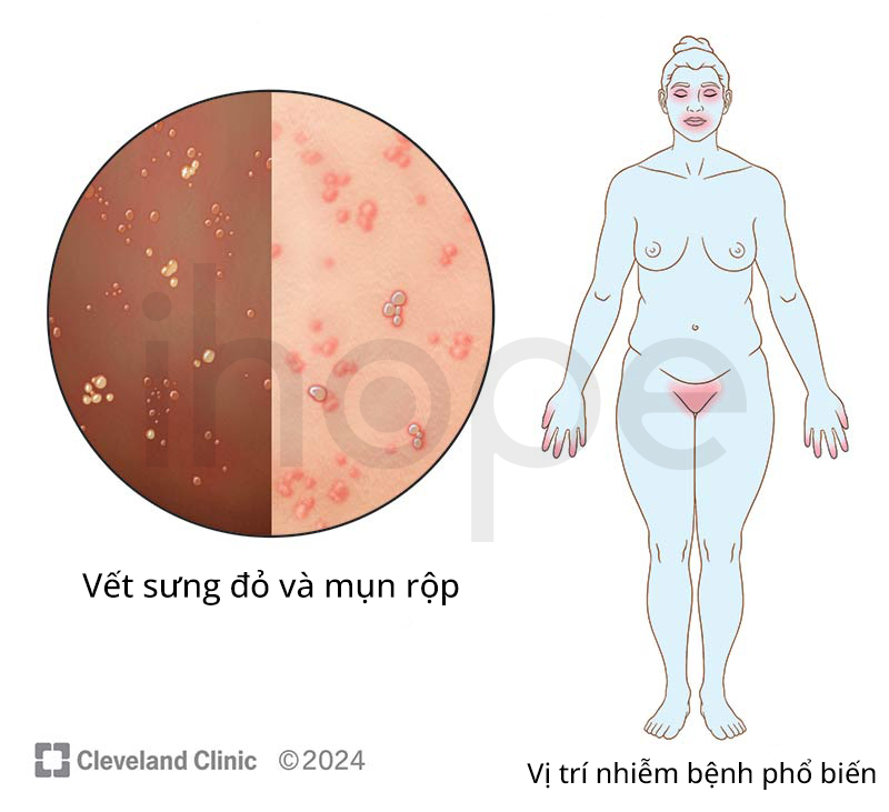 Nhiễm Herpes Simplex Virus (HSV) ở phổi: Nguy hiểm thầm lặng khó lường 7 Các vị trí nhiễm Herpes Simplex Virus phổ biến
