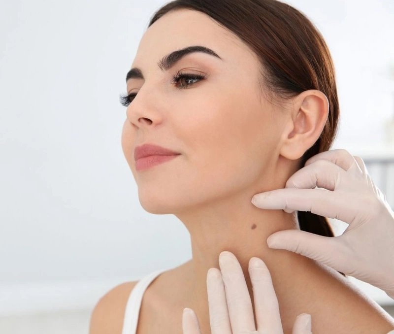 Phương pháp tẩy nốt ruồi hiệu quả
