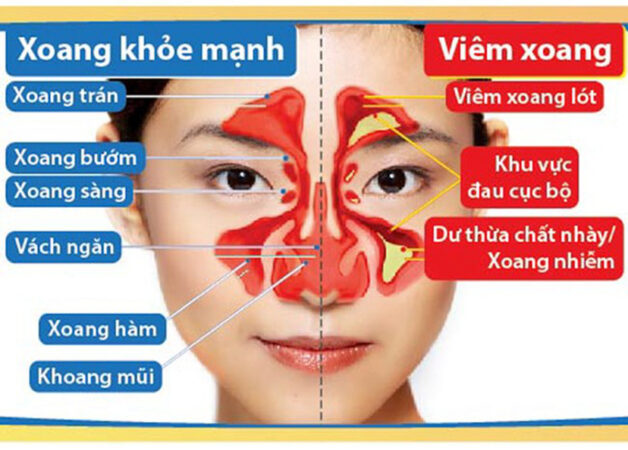 Hình ảnh minh họa viêm xoang mạn tính