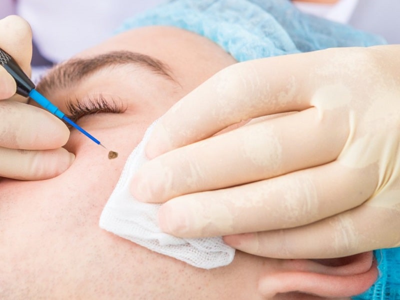 Tẩy nốt ruồi an toàn bằng laser
