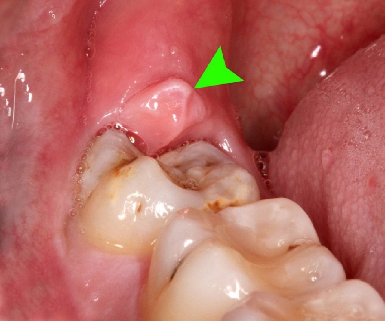 Sưng nướu do mọc răng khôn