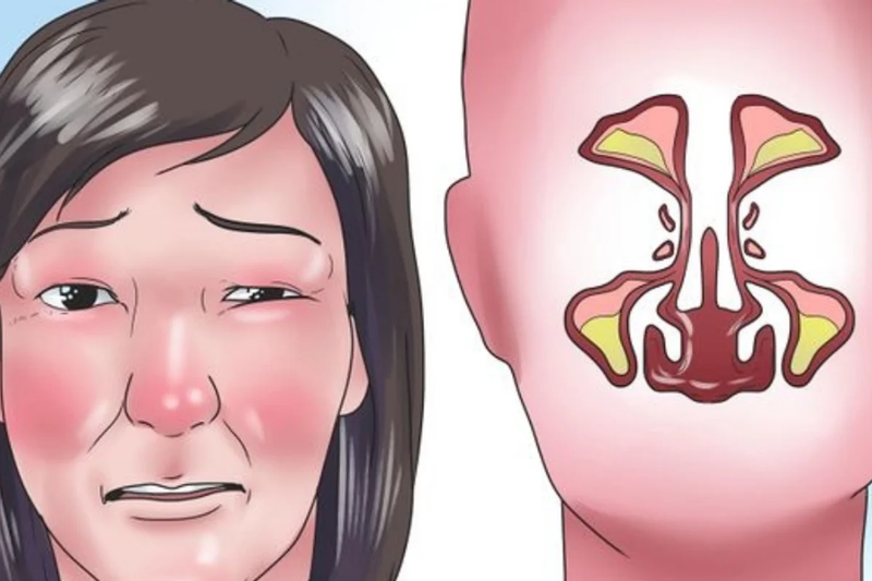 cách trị nghẹt mũi tại nhà hiệu quả