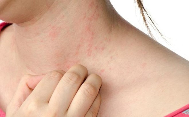Cảm giác châm chích: Nguyên nhân, triệu chứng và cách xử lý hiệu quả 7 Hình ảnh cảm giác châm chích khắp người