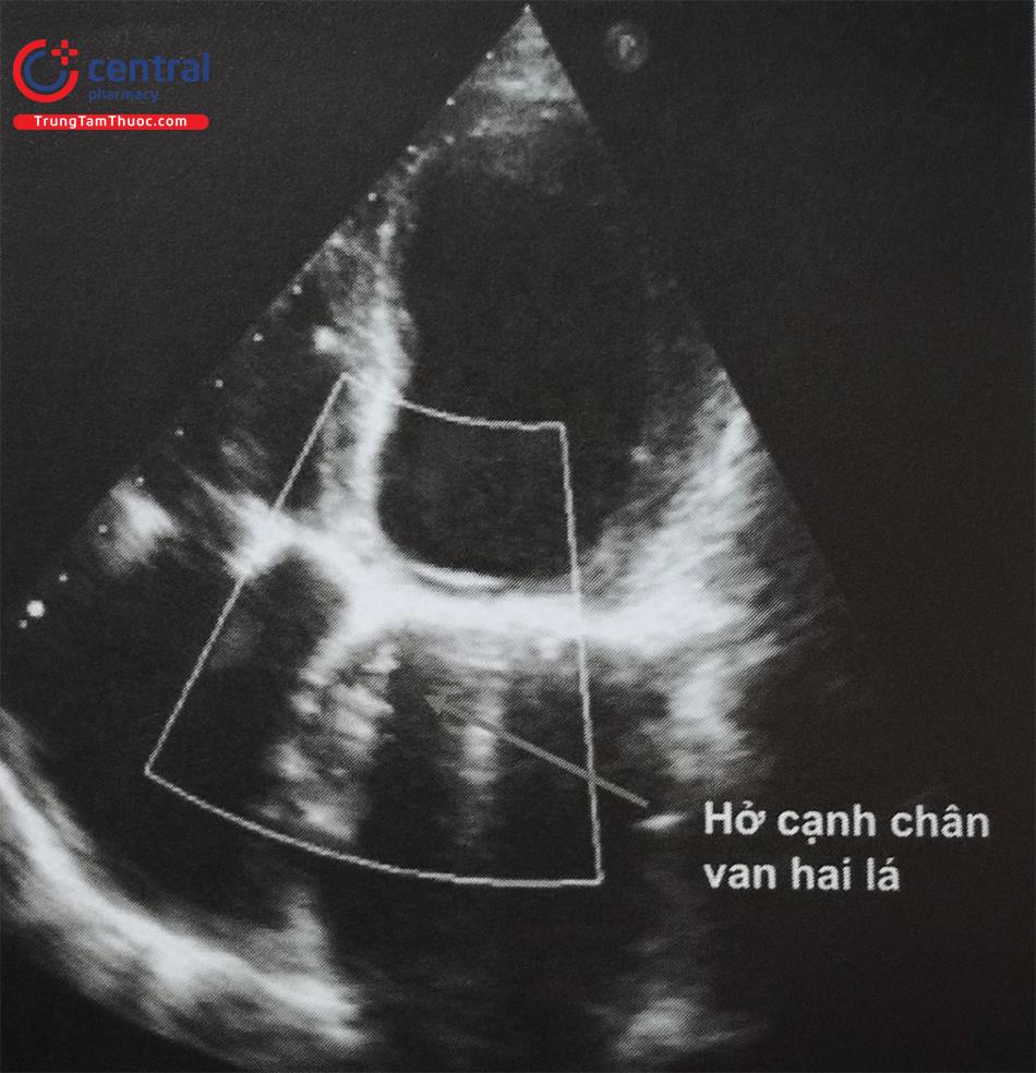 Siêu âm tim phát hiện hở cạnh van nhân tạo