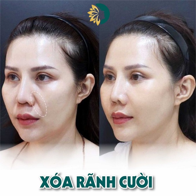 căng chỉ nâng cung mày và xóa rãnh cười