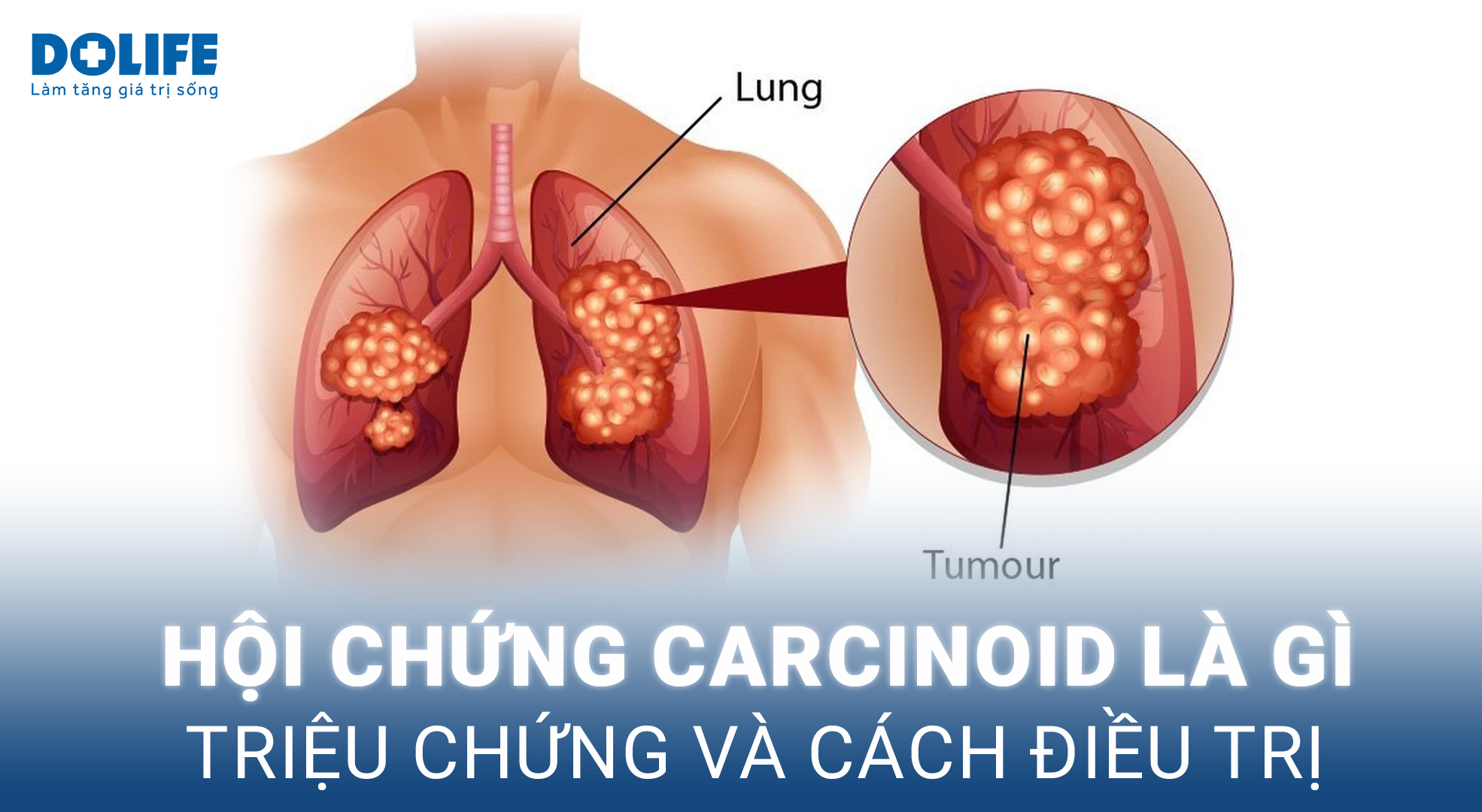 Hình ảnh nội soi u carcinoid phế quản