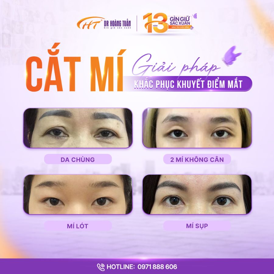 Cắt mí dành cho ai