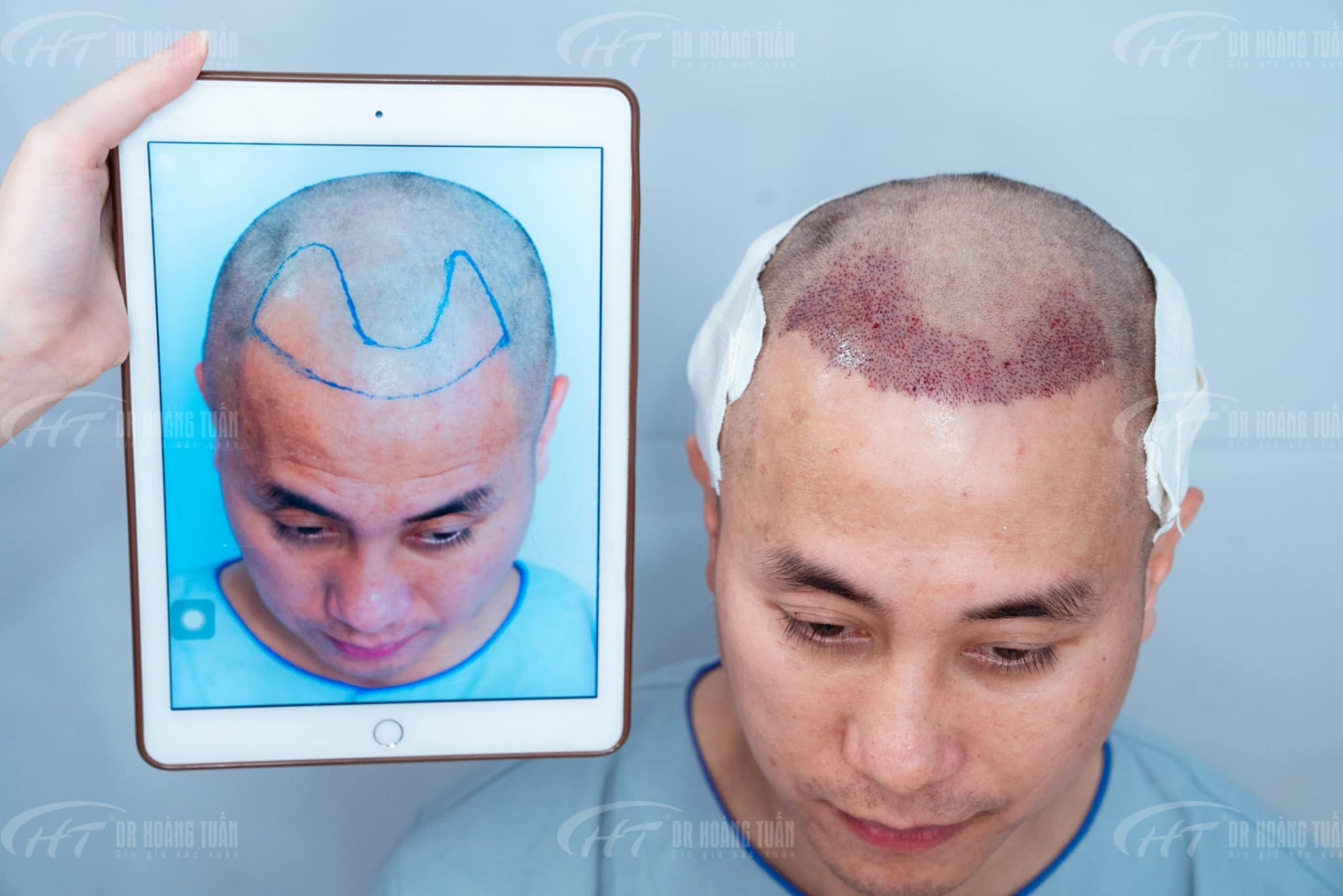 Trước khi cấy tóc