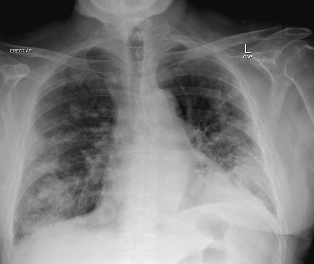CT scan amyloidosis phổi