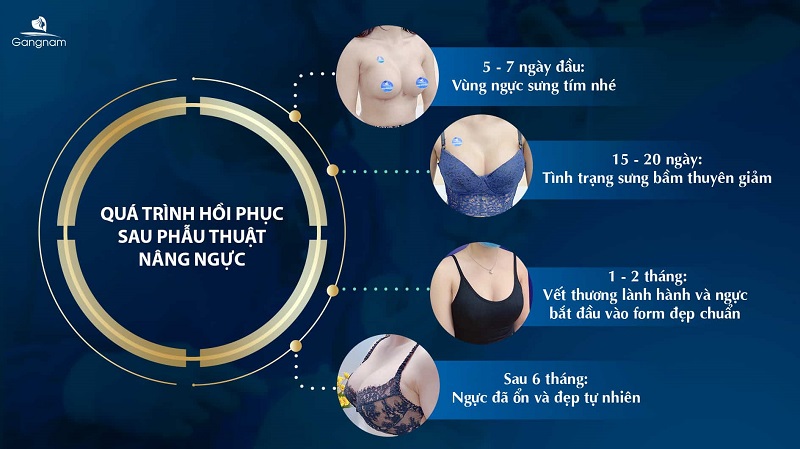 Chăm sóc sau nâng ngực ngày đầu tiên