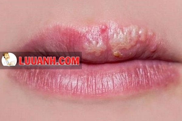 Biểu hiện chàm môi