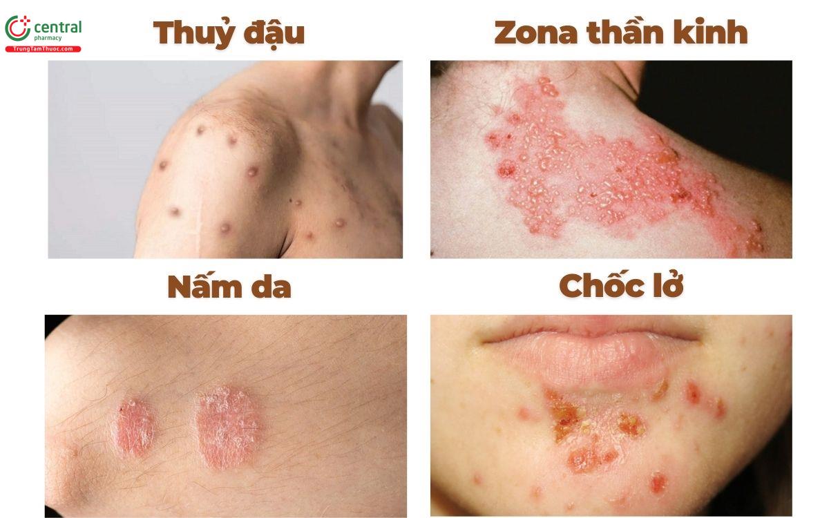 phân biệt chốc lở da liễu