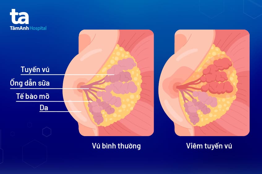 Chẩn đoán viêm tuyến vú