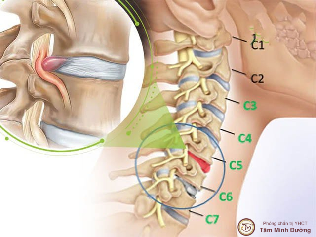 Bệnh Lý Rễ Thần Kinh Cổ: Nguyên Nhân, Triệu Chứng và Hướng Điều Trị 8 Điều trị chèn ép rễ thần kinh cổ