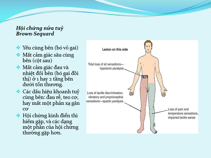 Hội chứng chèn ép tủy: Nguyên nhân, triệu chứng và phương pháp điều trị 8 Mô phỏng giải phẫu tủy sống bị chèn ép