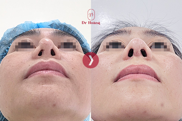 Hình ảnh mô phỏng phẫu thuật mở rộng lỗ mũi sau