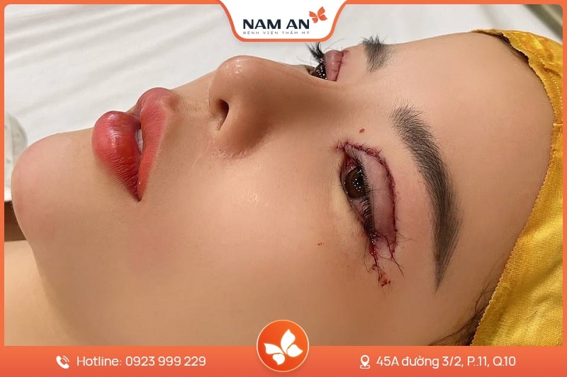 sửa mí hỏng