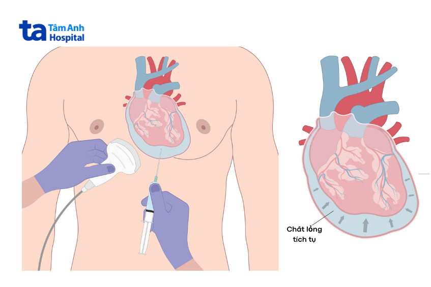 Chèn Ép Tim Cấp: Nguyên Nhân, Dấu Hiệu, Chẩn Đoán và Điều Trị 8 Kỹ thuật chọc hút dịch màng ngoài tim