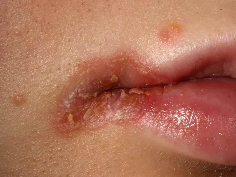 Hình ảnh nứt khóe miệng
