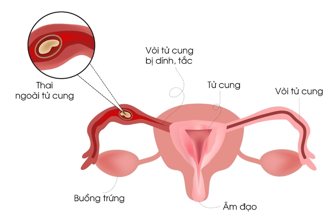 Hình ảnh phẫu thuật thai ở loa vòi