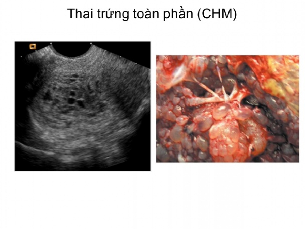 siêu âm thai trứng bán phần